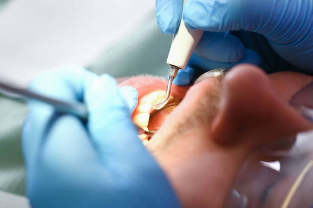 Best Emergency Dentist for Knocked-Out Tooth in Rayne, LA